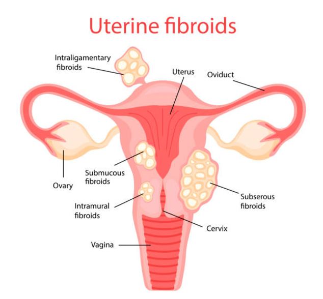 Herbs to Avoid if You Have Fibroids