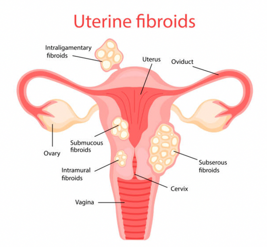 Herbs to Avoid if You Have Fibroids